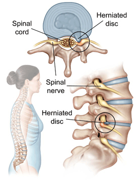 Lumbar Disc Herniation - Atlantic Spine Specialists