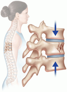 compression fracture treatment nj