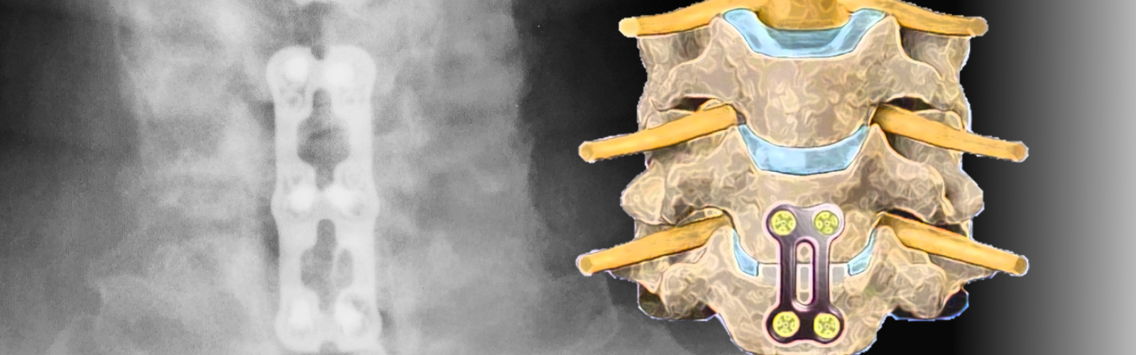 Anterior cervical discectomy and fusion | Atlantic Spine Specialists | NJ