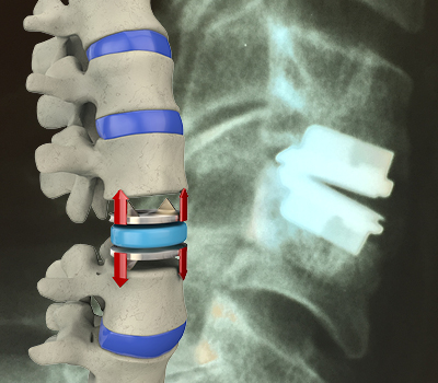 CERVICAL DISC REPLACEMENT