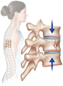 3 Types of Spinal Fractures - Dr. Nael Shanti