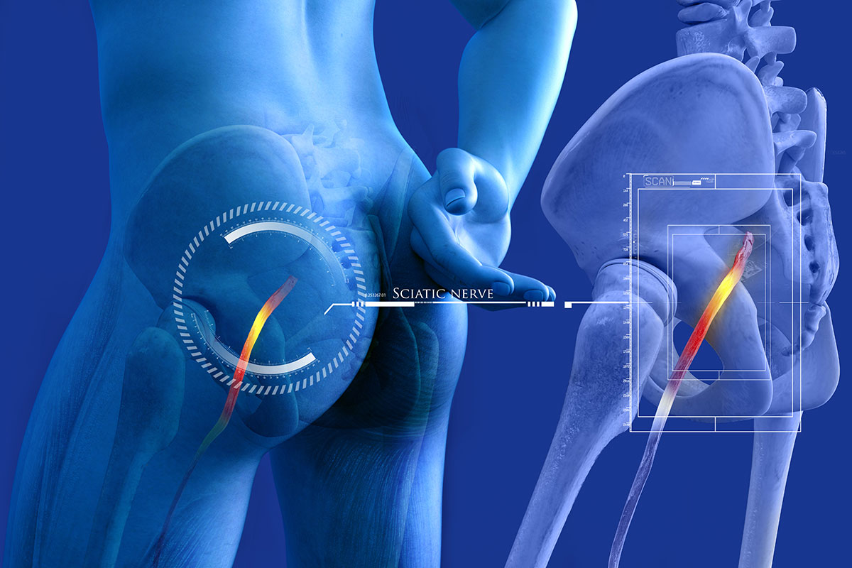 Therapia - Physiotherapy for Sciatica