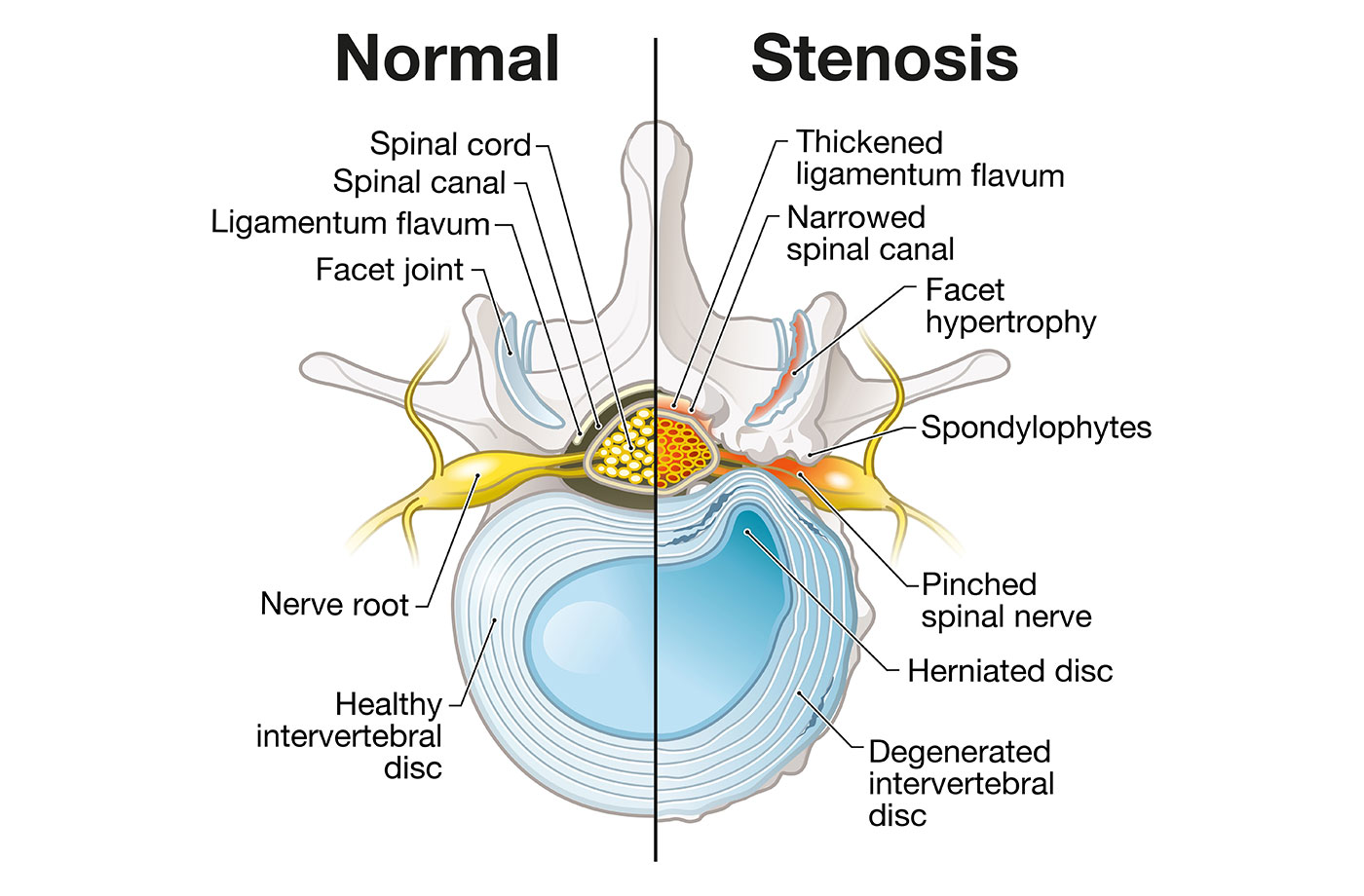 Lower Back Pain: Causes, Symptoms, Diagnosis & Treatment