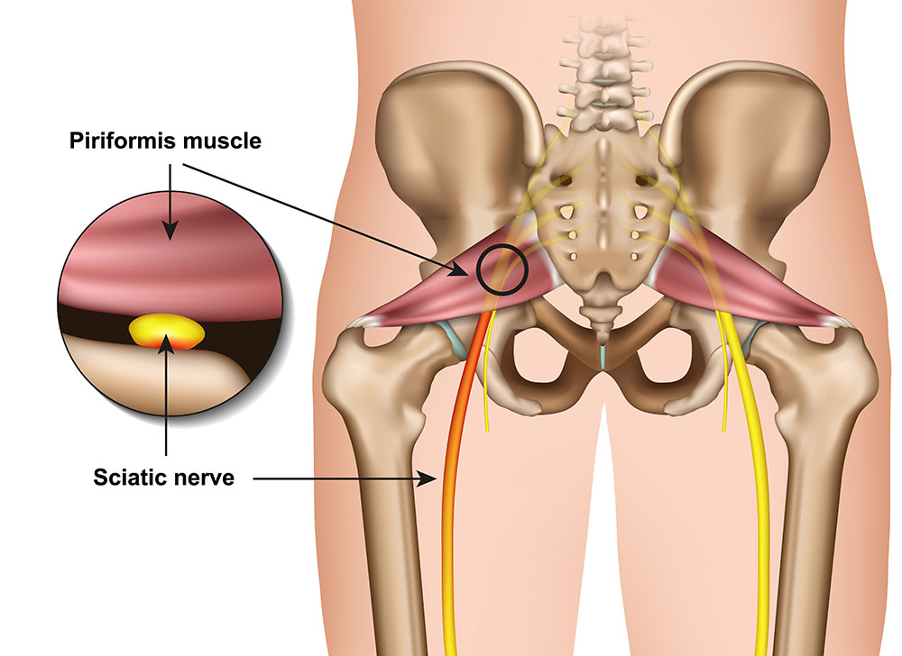 Understanding Sciatica: Causes, Symptoms, and Treatment Options