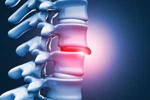 What Is Lumbar Disc Herniation