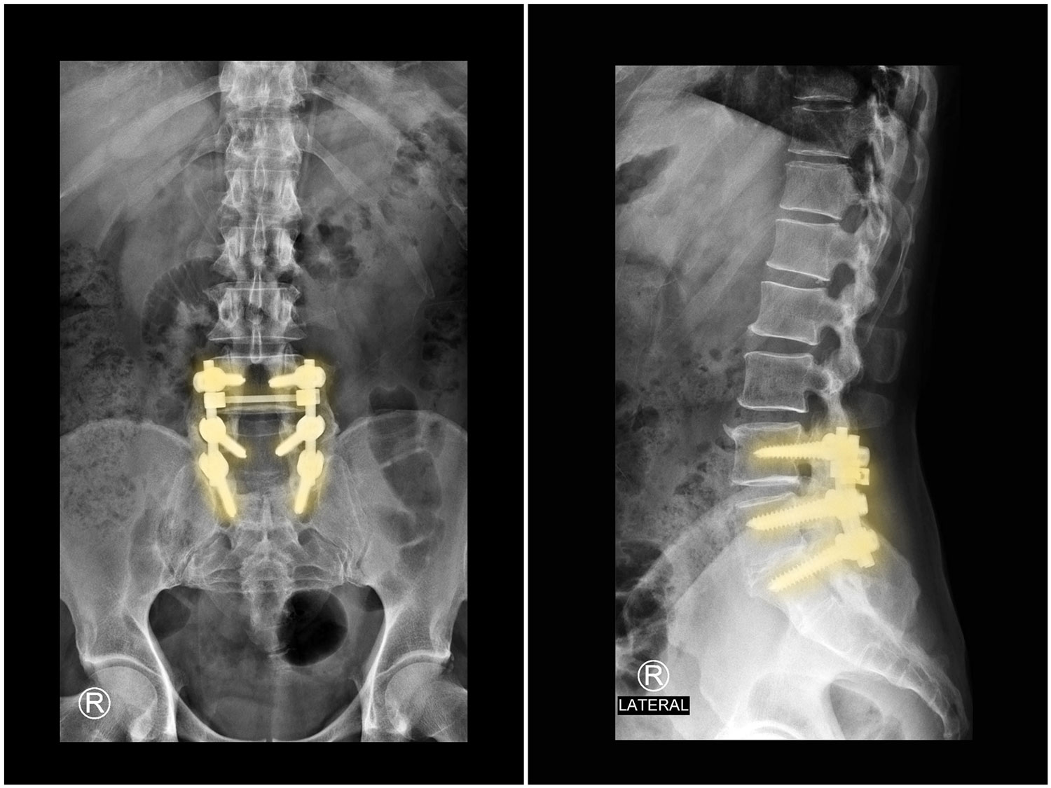 Lumbar Spinal Fusion: Surgical Treatment for Chronic Low Back Pain
