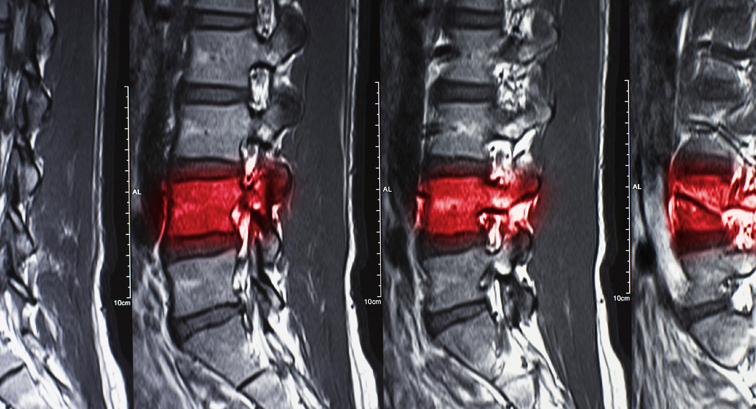 Understanding Spinal Fractures: Causes, Types and Treatment