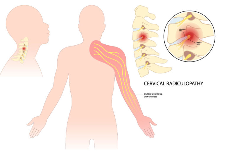 Understanding Cervical Radiculopathy: Causes, Symptoms and Treatment