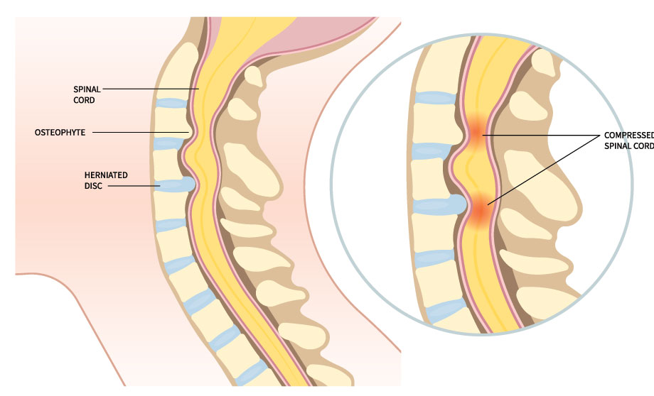 Cervical Myelopathy: A Serious Spinal Cord Condition