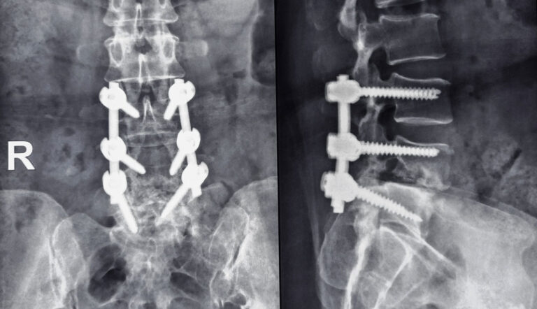 Richard S. Nachwalter, MD Insights on Luigi Mangione’s Back Pain and Spinal Fusion Surgery