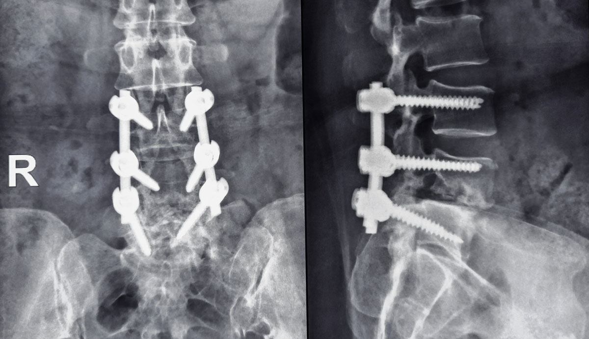 Richard S. Nachwalter, MD Insights on Luigi Mangione’s Back Pain and Spinal Fusion Surgery